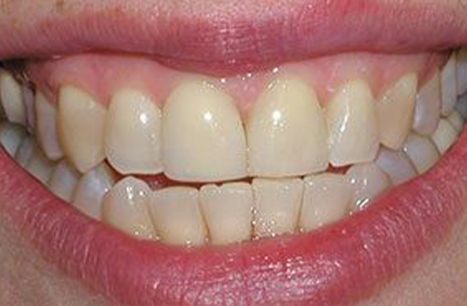 Perfected smile after cosmetic dental bonding