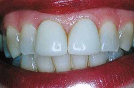 Smile with discoloring before cosmetic dental bonding