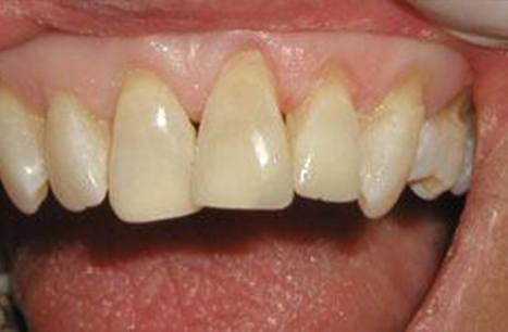 Gorgeous smile after cosmetic dental bonding