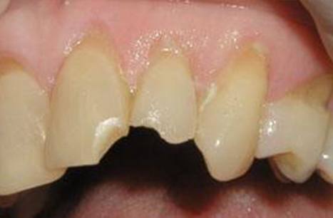 Broken and discolored teeth before cosmetic dental bonding