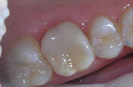 Closeup of smile repaired with CEREC dental crown restoration