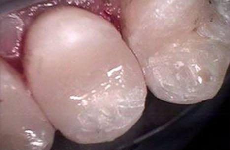 Smile repaired with CEREC dental restoration