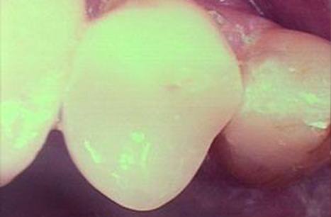 Teeth restorated with CEREC dental crowns