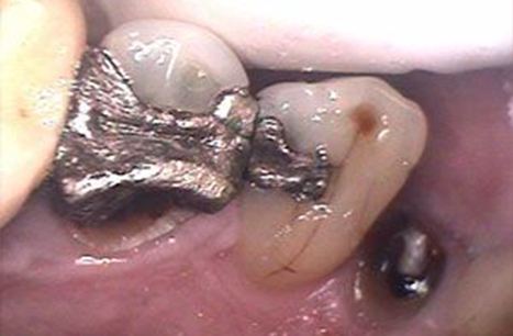Teeth with large metal fillings