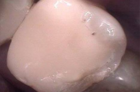 Tooth restored with CEREC dental crown restoration