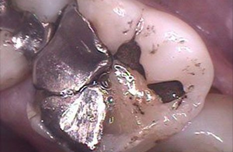 Tooth with broken metal filling