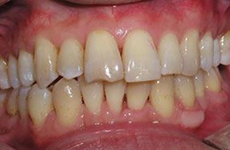 Properly aligned smile after ClearCorrect orthodontics