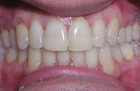 Smile after crossbite is corrected with ClearCorrect orthodontics