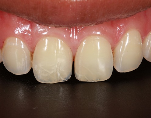 Smile with cracked teeth before cosmetic dental bonding