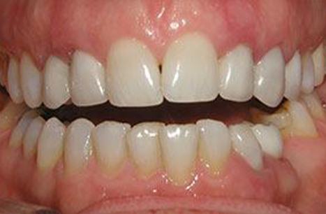 Discolored smile before dental crown restoration