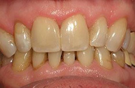 Fully repaired smile after dental crown restoration