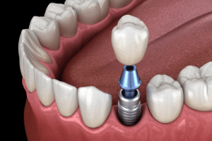 Diagram of single tooth dental implants in Randolph being placed