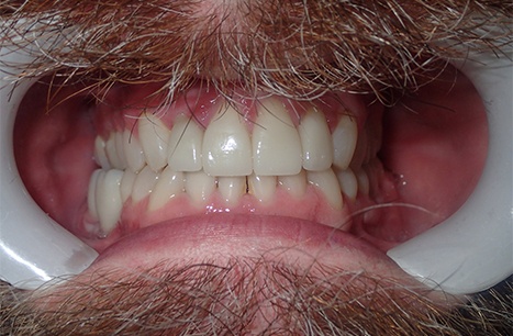 Dame Case - Bone Grafts, Tissue Grafts, Clear Braces, Implant Placement, Implant Crowns and Cosmetic Crowns and Veneers