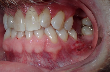 Dame Case - Bone Grafts, Tissue Grafts, Clear Braces, Implant Placement, Implant Crowns and Cosmetic Crowns and Veneers
