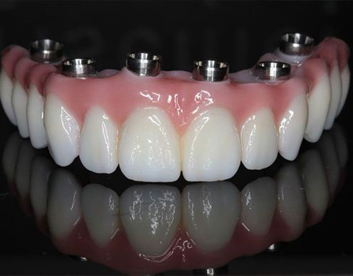 Prettau dental implant supported bridge prior to placement