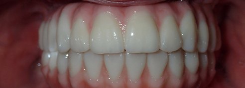Flawless healthy smile after cosmetic dentistry treatment