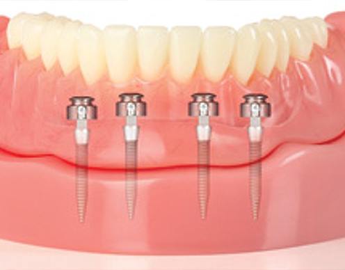Animated smile with mini dental implant supported denture
