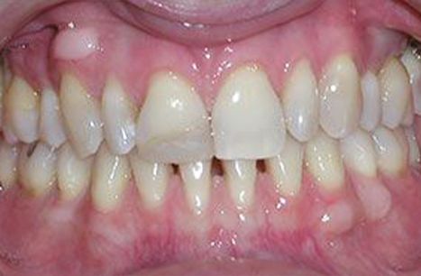Discolored teeth and gum tissue recession