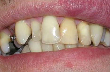 Severely damaged and discolored teeth before porcelain veneers
