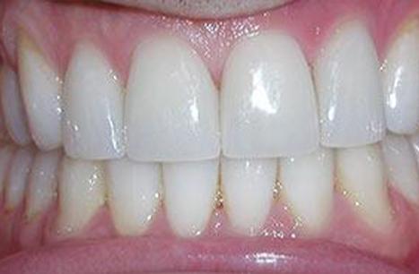 Picture perfect smile after porcelain veneers