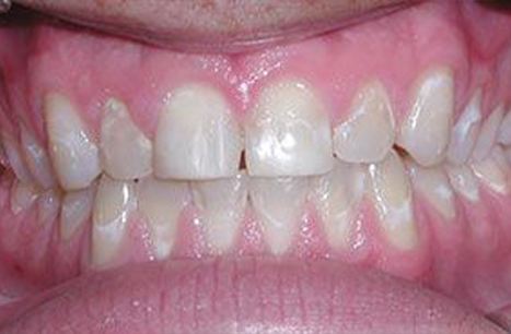 Worn and unevenly spaced teeth before porcelain veneers
