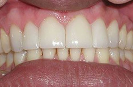 Perfectly spaced teeth after porcelain veneers