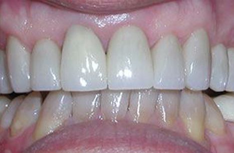 Restoration replaced with flawless porcelain veneers