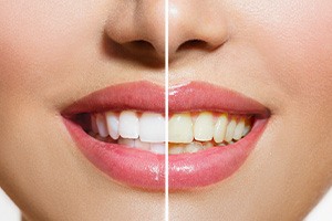 Closeup of a woman’s smile that’s half whitened to show before and after results
