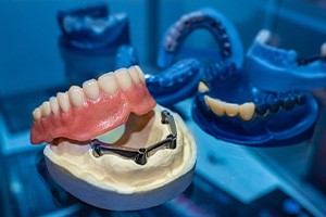 Implant dentures resting on model jaw with posts with impressions in the blue background