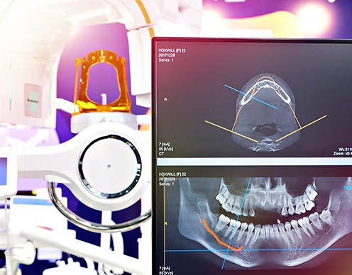 Computer guided dental implant surgery plans