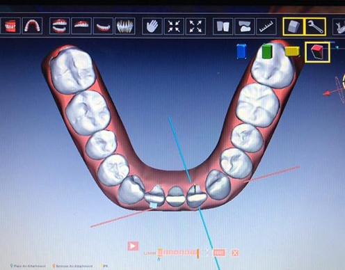 3 D rendering of smile on chairside computer