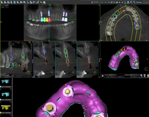 Computer guided dental implant placement plans