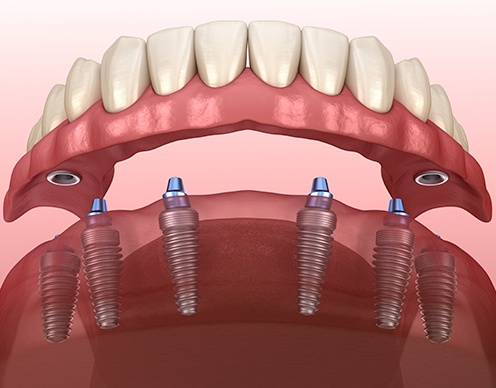 Animated All on 4 dental implant supported denture