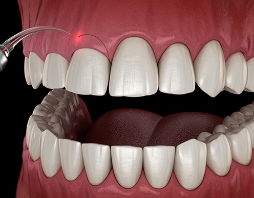 Animated iLase dental laser treatment