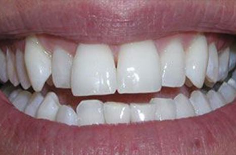 Yellow smile after teeth bleaching