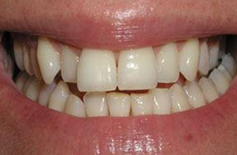 Yellow smile before teeth bleaching