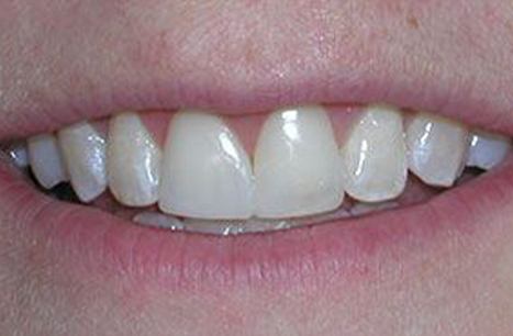 Gorgeous smile after cosmetic dental bonding