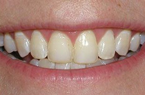 Flawed smile before cosmetic dental bonding