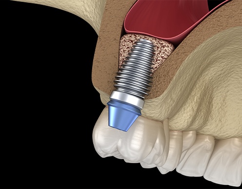 Animated bone grafting process