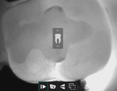 Image from CariVu cavity detection system