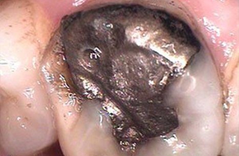 Closeup of severely decayed tooth before CEREC dental crown restoration