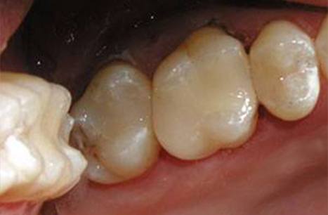 Teeth repaired with CEREC one visit dental restorations