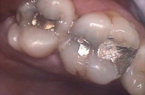 Teeth with metal fillings before CEREC dental restoration