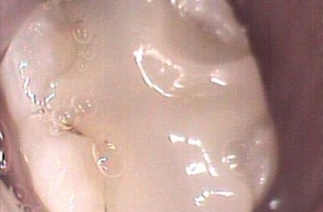 Damaged tooth before CEREC dental restoration