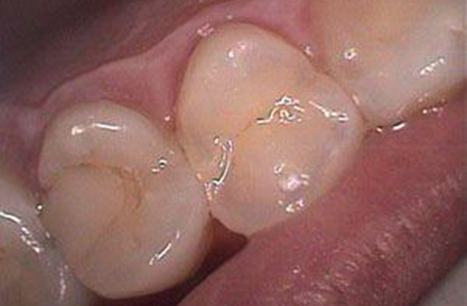 Decayed tooth before CEREC dental restoration