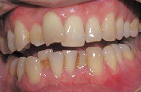 Misaligned and overlapped teeth before ClearCorrect orthodontics