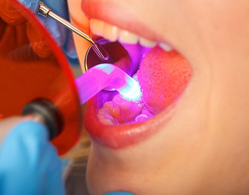 Closeup of patient receiving cosmetic dental bonding