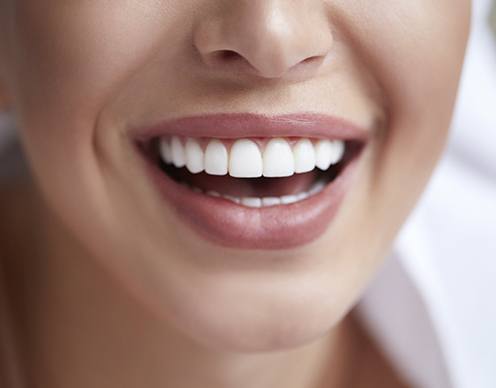Closeup of smile with porcelain veneers after cosmetic dentistry