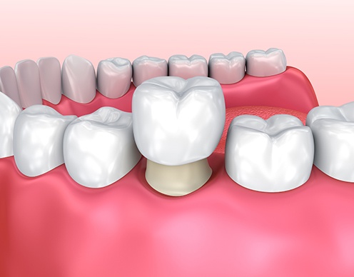 Aniamted dental crown placement