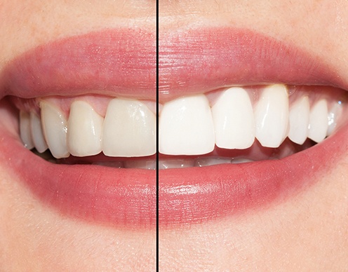 Smile before and  after teeth whitening